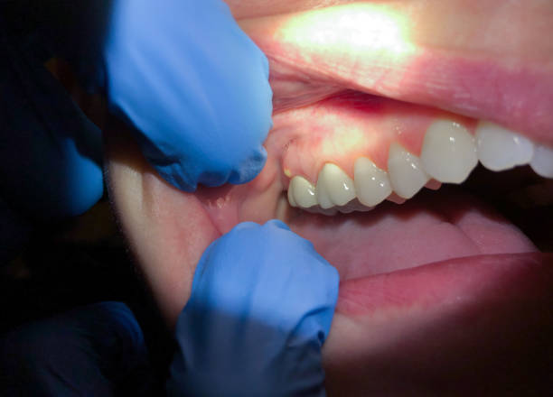 Best Chipped Tooth Repair Near Me  in Algood, TN